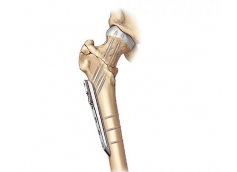 Implantáty, fixatéry a nástroje
